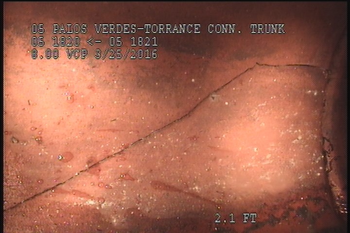 Fracture Circumferential, from 07 to 09 o'clock, within 8 inches of joint: YES