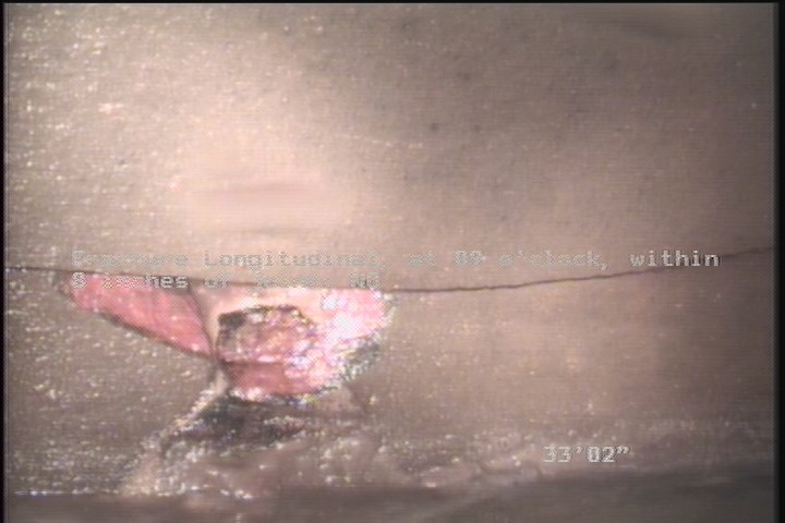 Fracture Longitudinal, at 09 o'clock, within 8 inches of joint: NO
